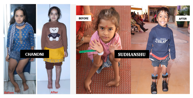 Narayan Seva Sansthan leads inclusive change with over 4.5 lakh free surgeries